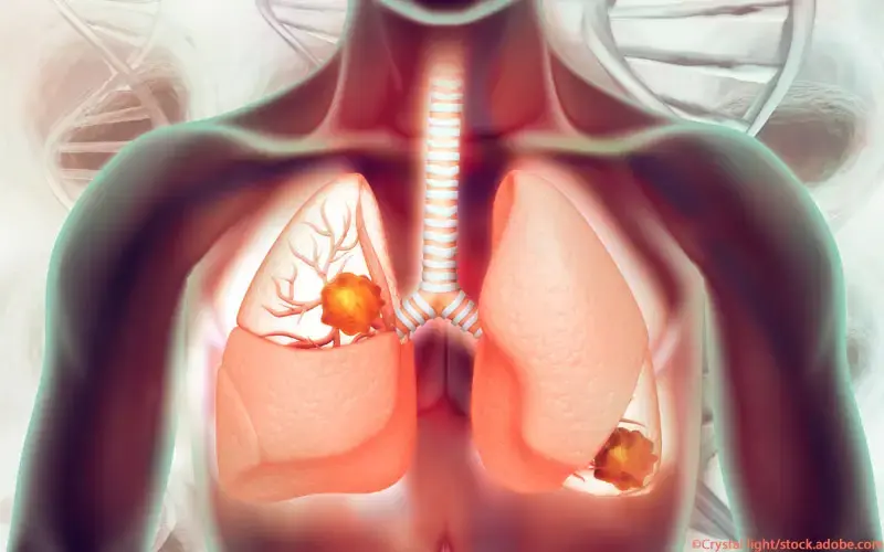 Bronchialkarzinom NSCLC