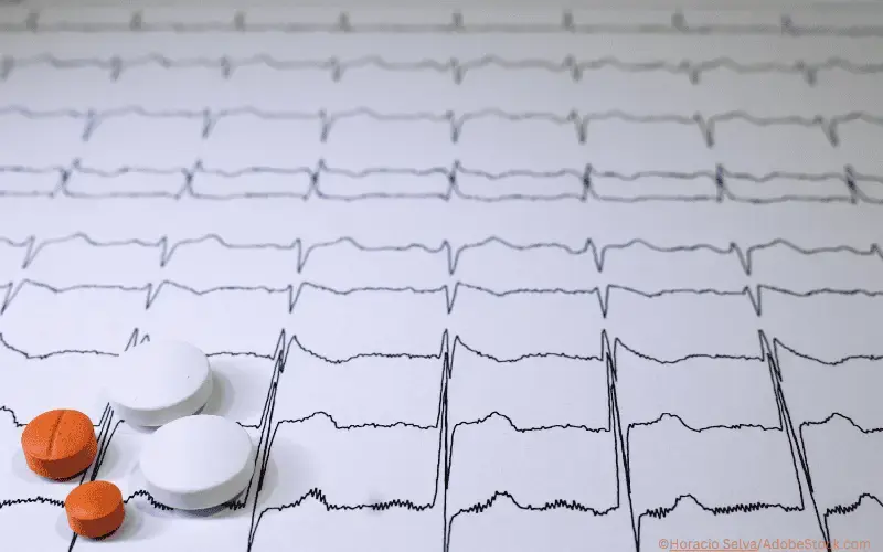 Brugada-Syndrom Elektrokardiogramm