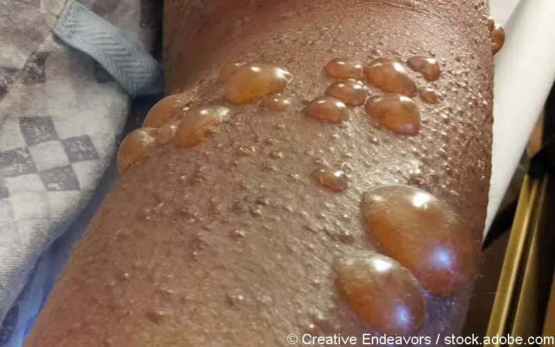 Bullöses Pemphigoid