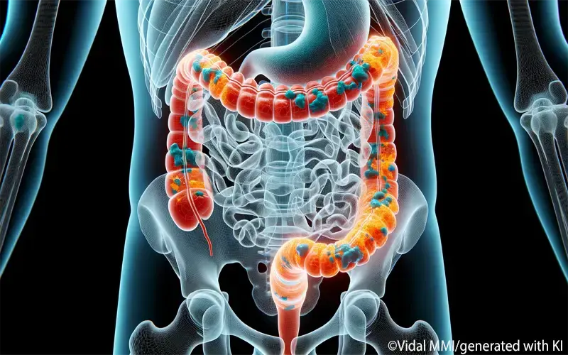 Colitis ulcerosa 2
