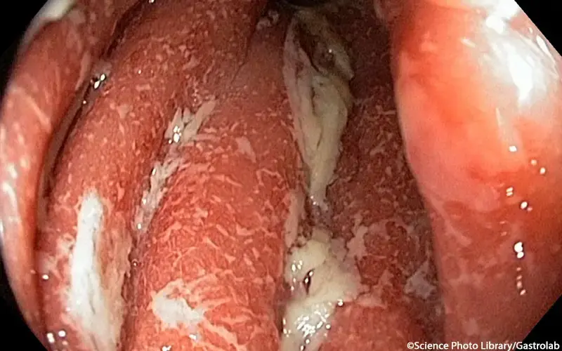Colitis ulcerosa