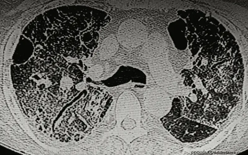 CT-Scan interstitielle Lungenkrankheit