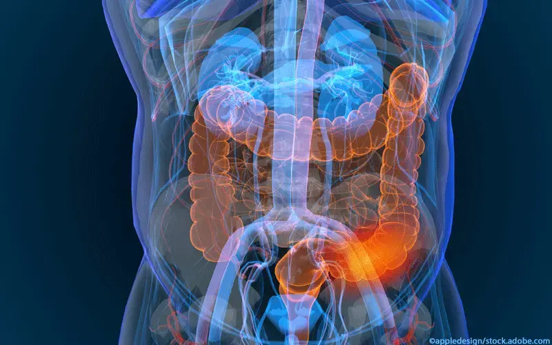 Darmkrebs illustriert