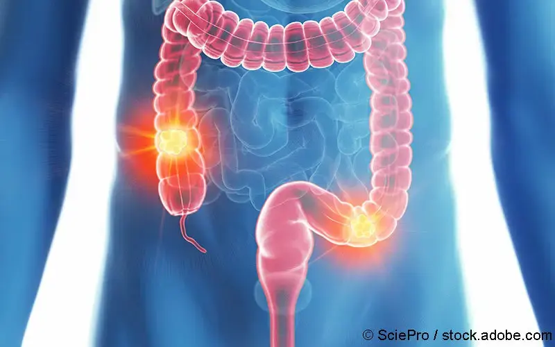 Darmkrebs Mann