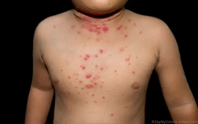 Dellwarzen-molluscum-contagiosum
