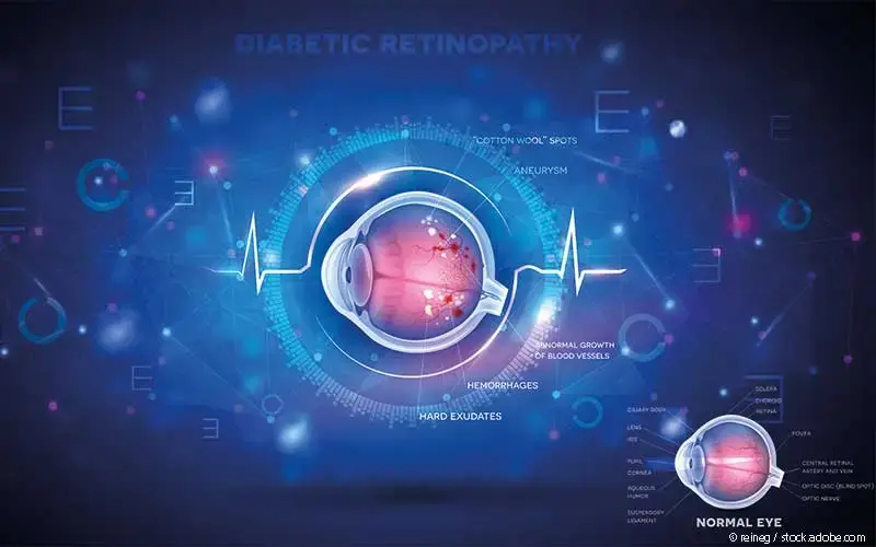 Diabetische Retinopathie Schaubild