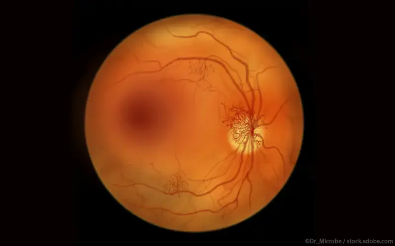 Diabetische Retinopathie