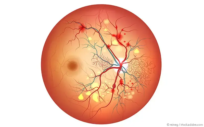 Diabetische Retinopathie