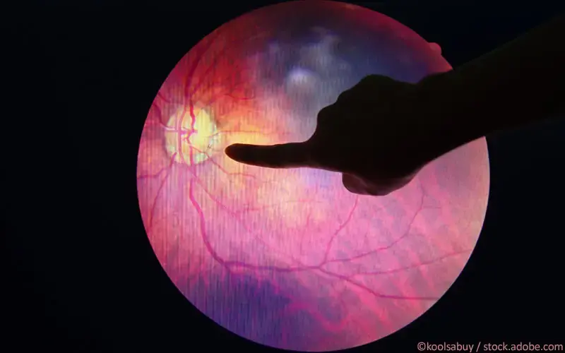 Diabetisches Makulaödem
