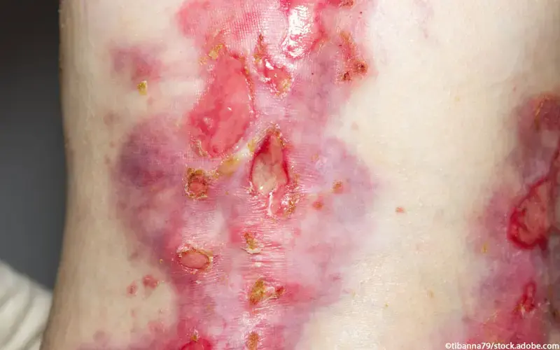 Epidermolysis bullosa 