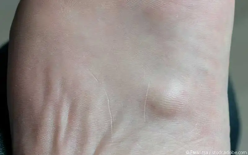 Fibromatose