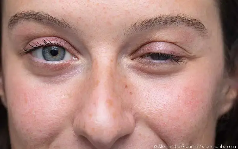 Frau Myasthenia gravis