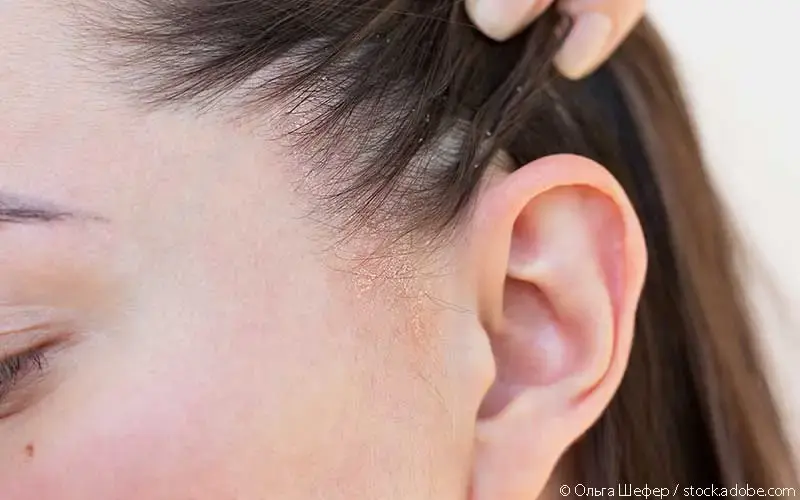 Frau Seborrhoische Dermatitis