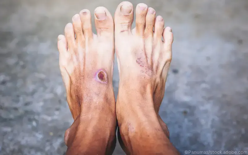 Gangraen-Pyoderma-gangraenosum-Nekrose