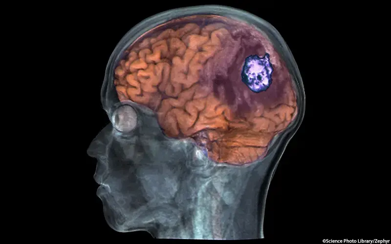 Gliom Gehirntumor