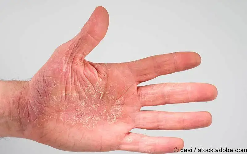 Handekzem chronisch 