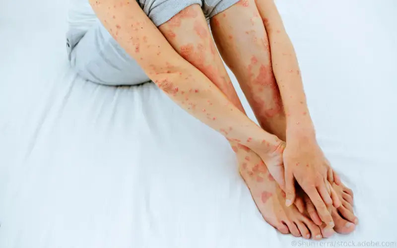 Hautausschlag-Lichenoid-Psoriasis