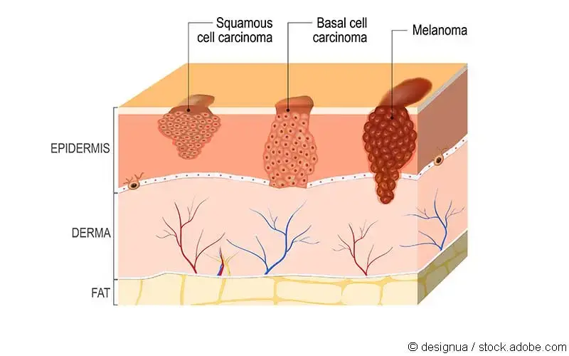 Hautkrebstypen