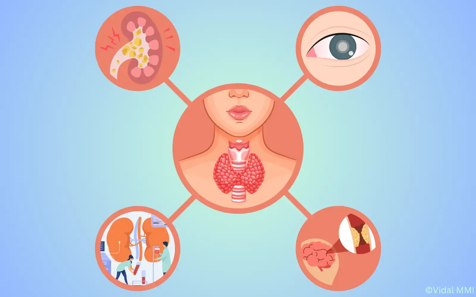 Hypoparathyreoidismus Komplikationen