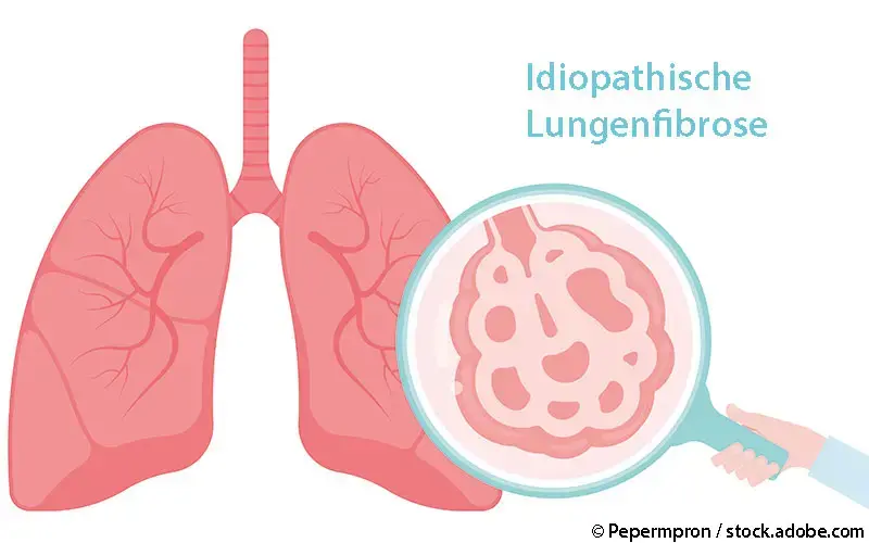 Idiopatische Lungenfibrose