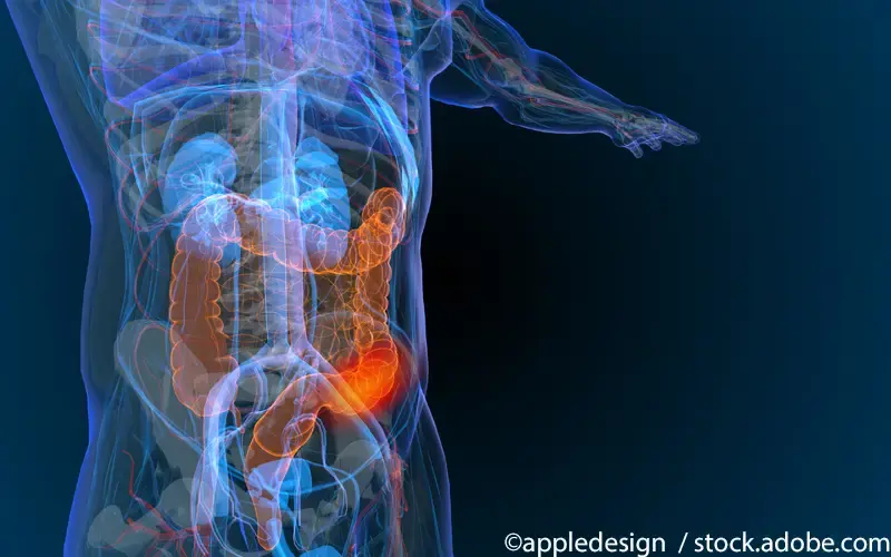 Kolorektales Karzinom 2