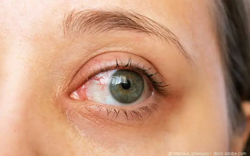 Konjunktivitis sicca