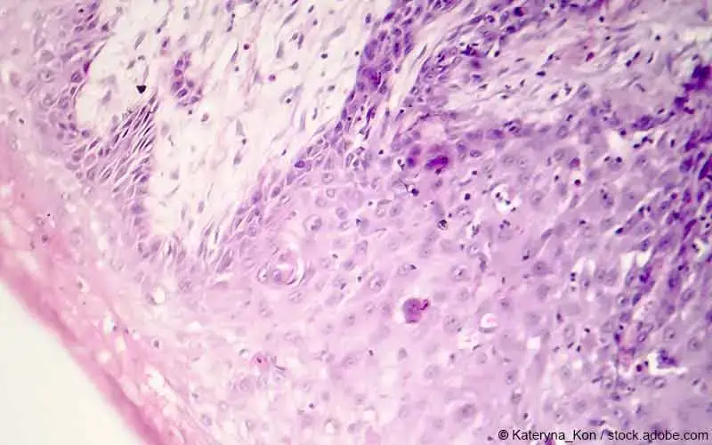 kutanes-plattenepithelkarzinom