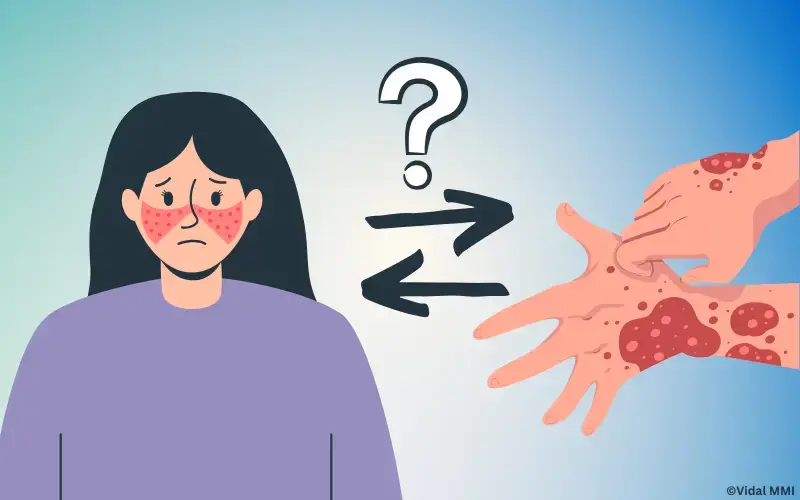 Lupus erythematodes atopische Dermatitis