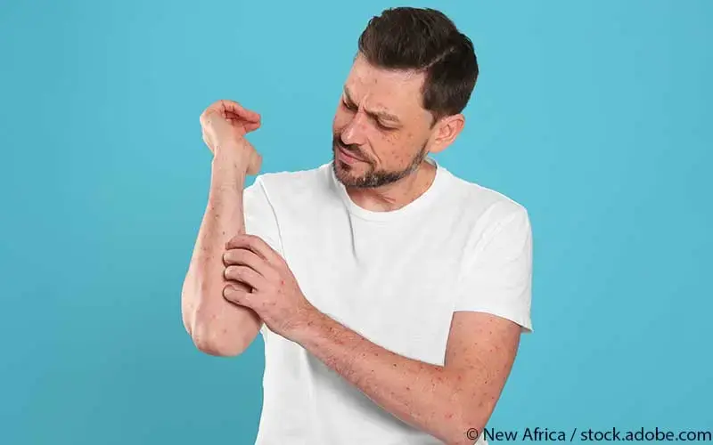 Mann mit Affenpocken