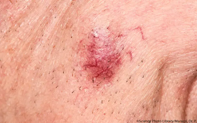 Merkelzellkarzinom Haut