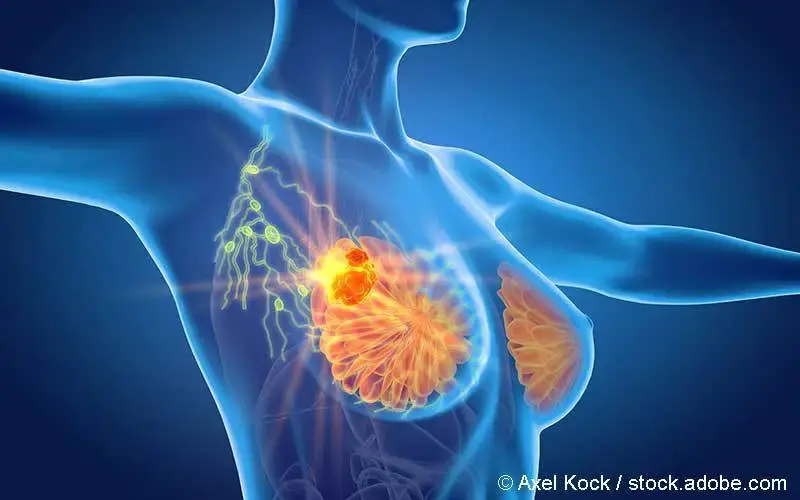 metastasierendes Mamma-Ca