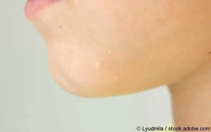 Molluscum contagiosum Nahaufnahme