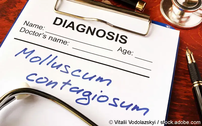 Molluscum Contagiosum