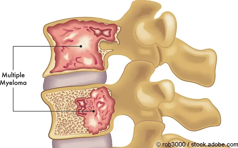 Multiples Myelom Grafik