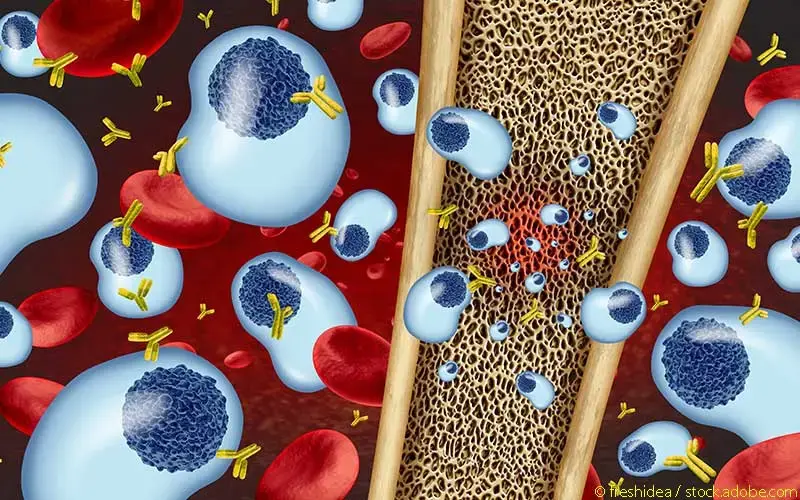 Multiples Myelom