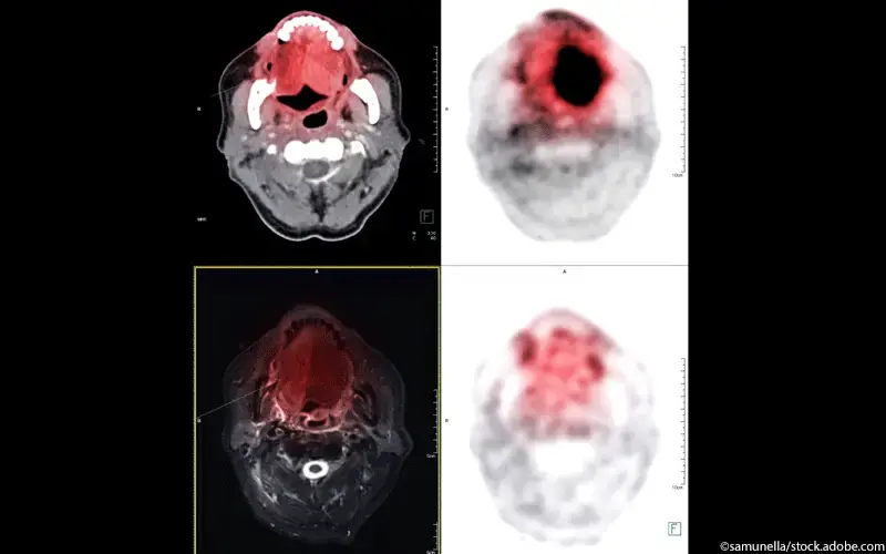 Nasopharynxkarzinom CT