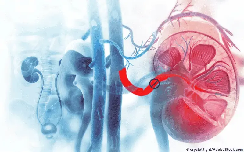 Nierenarterienstenose