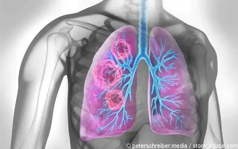 NSCLC