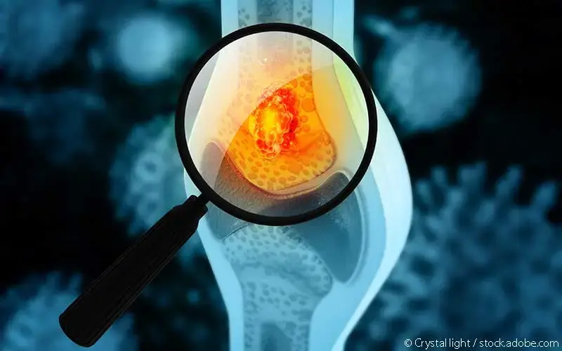 Osteosarkom