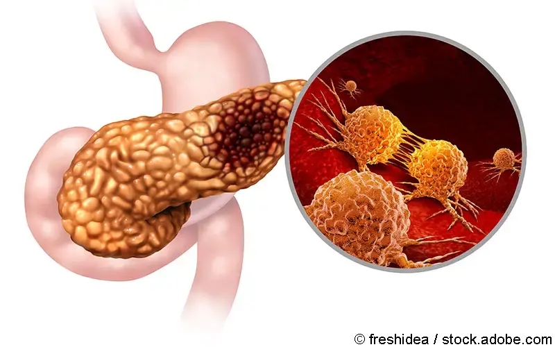 Pankreaskarzinom Detail