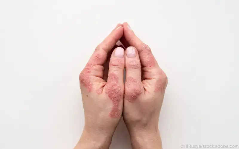 Plaque-Psoriasis