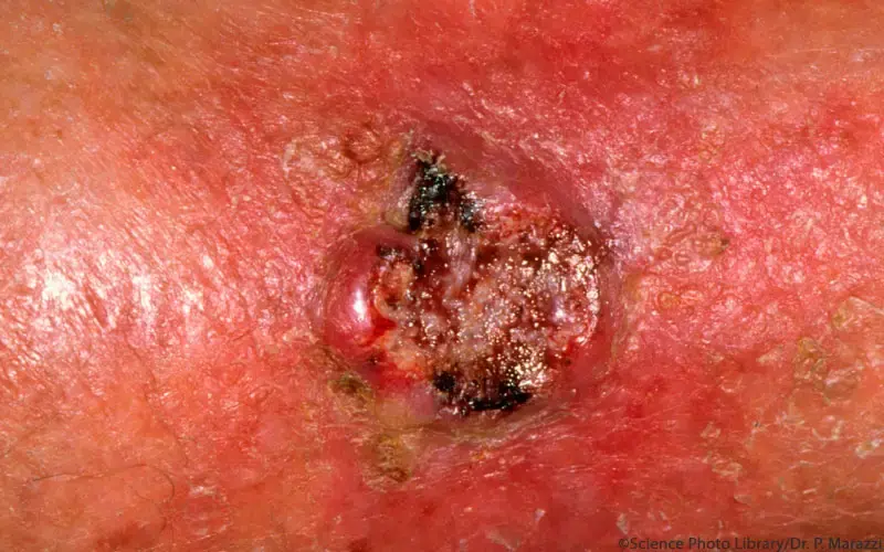 Plattenepithelkarzinom