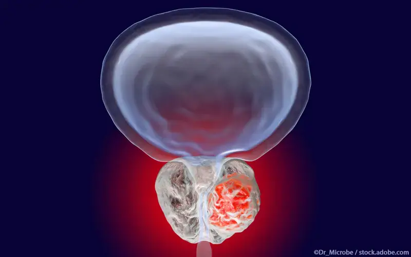 Prostatakarzinom