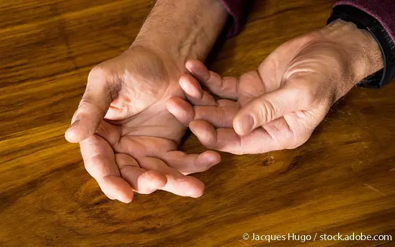 Psoriasis-Arthritis Haende Mann