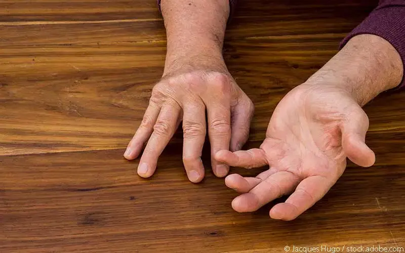 Psoriasis Arthritis Hände