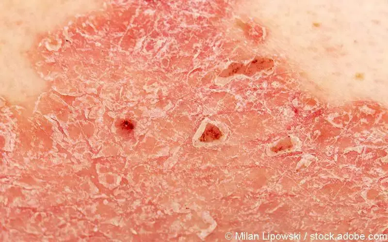 psoriasis-detailaufnahme