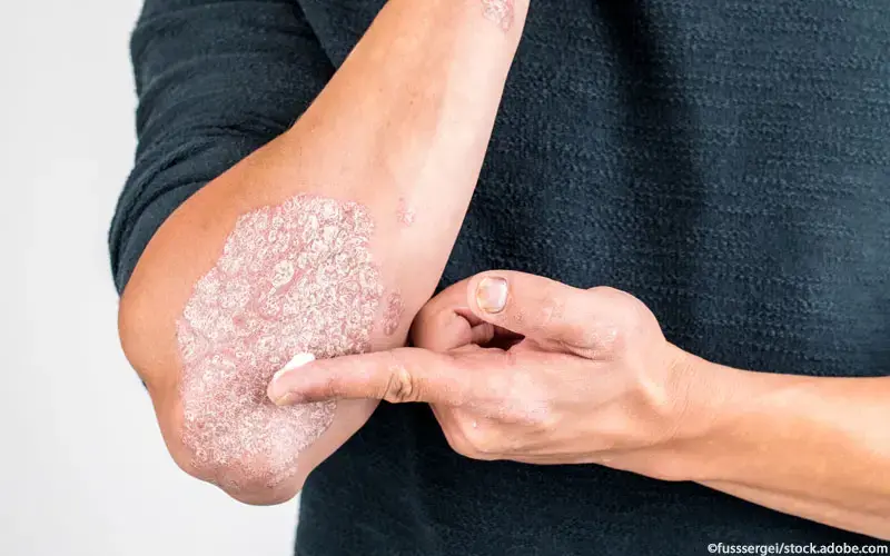 Psoriasis eincremen
