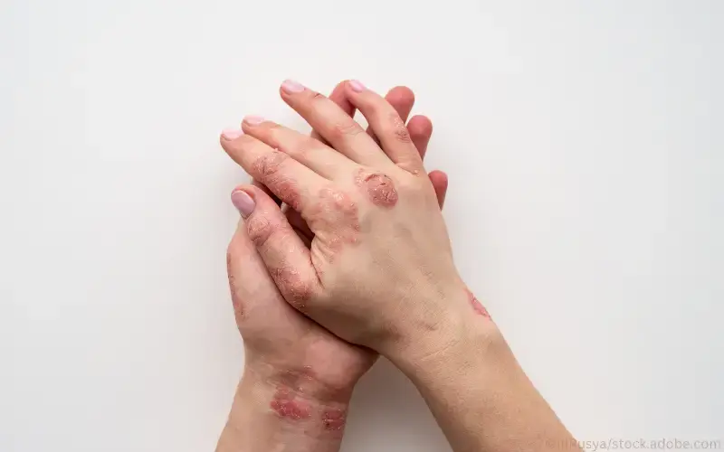 Psoriasis Hände