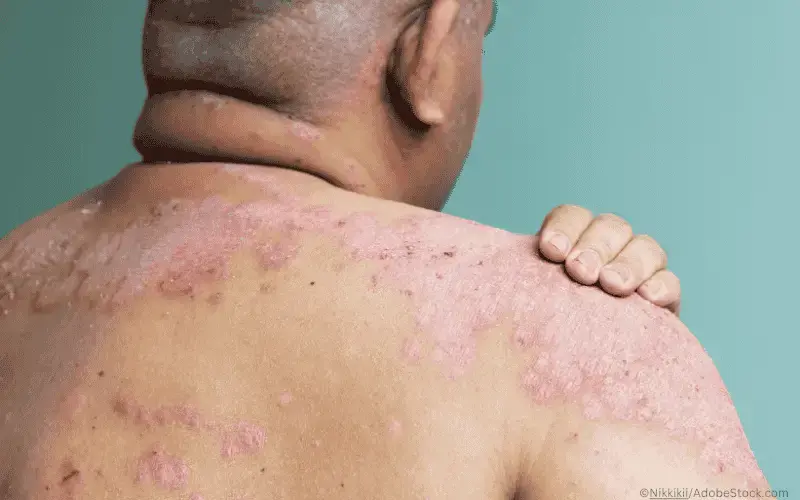 Psoriasis-Mann-Rücken