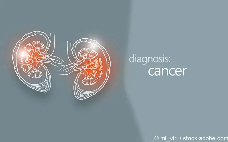 Renal Cell Carcinoma RCC